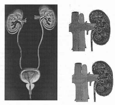 Ureteral stent.jpg